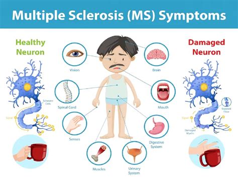 ms shynie|Multiple Sclerosis (MS): Early Warning Signs and .